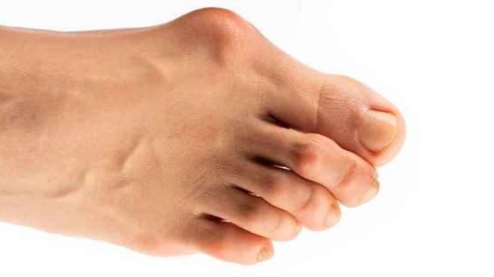 Yanlış Ayakkabı Seçimi Bu Hastalığa Zemin Hazırlıyor